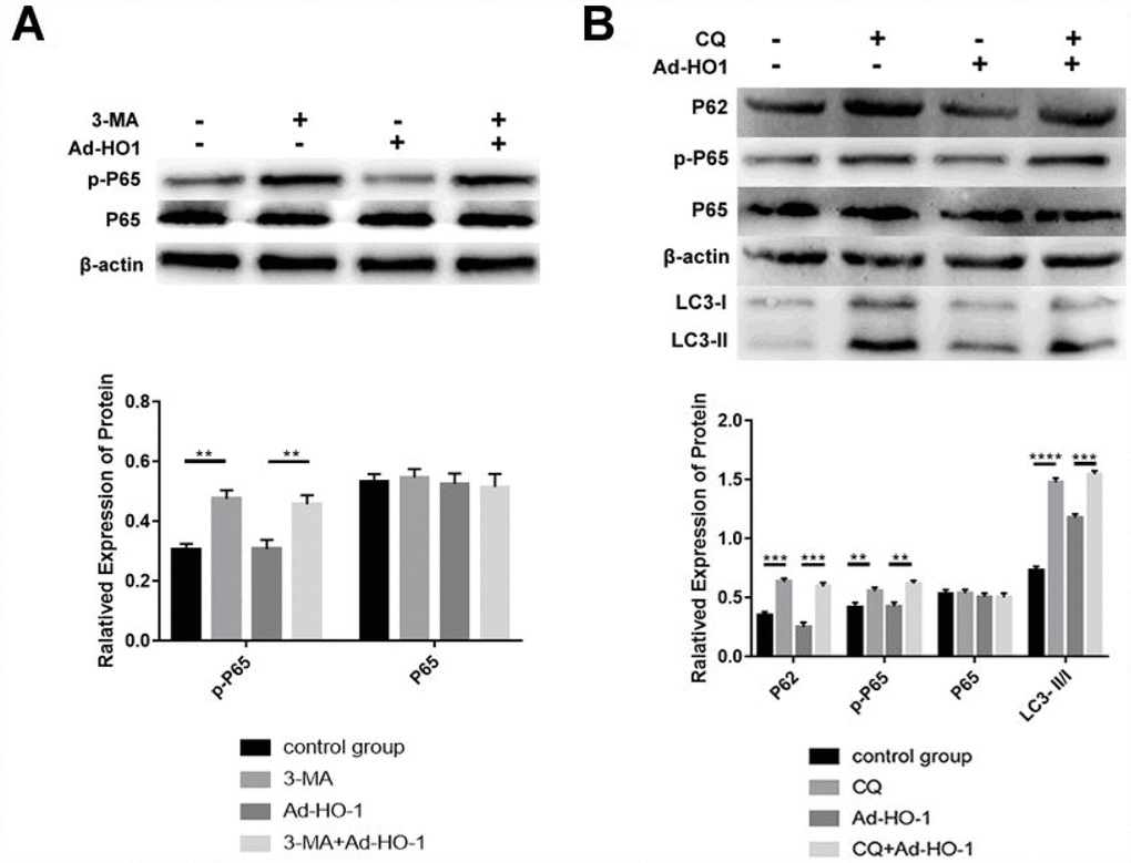 Autophagy induced by HO-1 inhibits the NF-κB pathway in NPCs. (A) Western blot analysis shows P65 and phospho-P65 protein alevels in NPCs transfected with Ad-HO-1 for 48 h and then treated with or without 10mM 3-MA for 24 h to inhibit autophagy. (B) Western blot analysis shows P65, p-P65, P62 and LC3-II/I protein levels in NPCs treated with 10mM CQ for 24 h after transfection with Ad-HO-1 for 48 h. Note: The data represent mean ± SD of three independent experiments; ****P