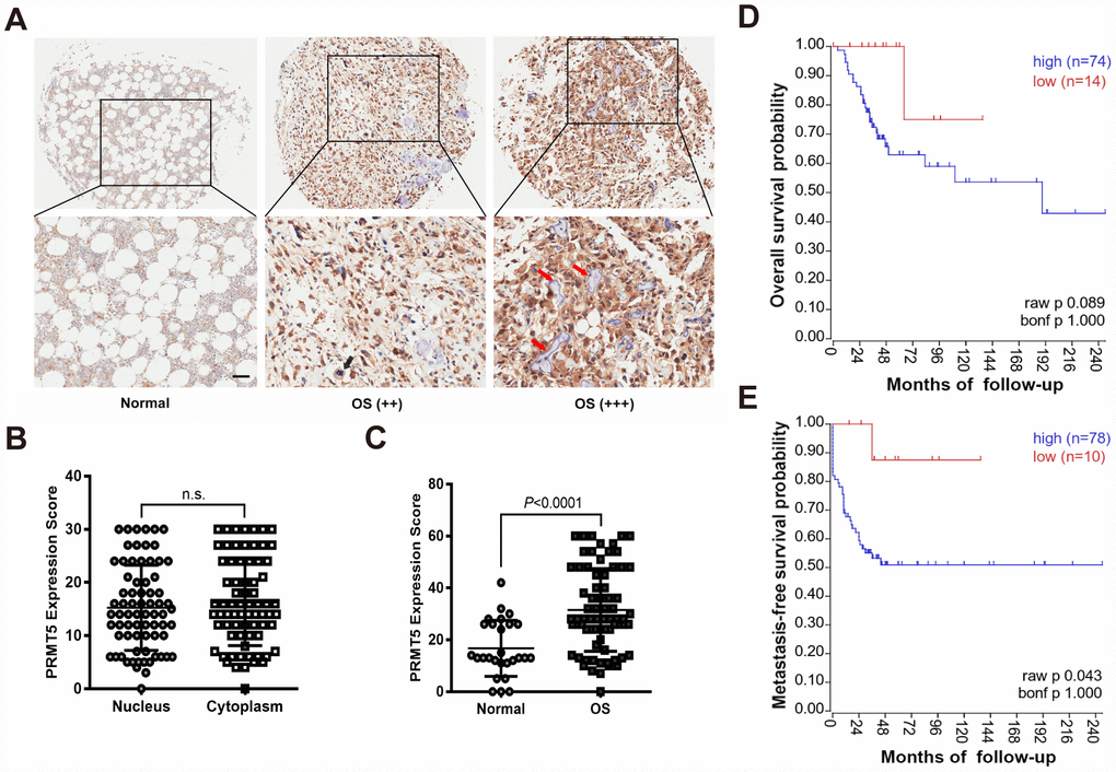 PRMT5 is overexpressed in OS tissues and its expression predicts poor survival probability. (A) The expression of PRMT5 was examined by IHC using commercial tissue microarrays (TMAs), which contained normal bone and different TNM stages of OS (++ indicated T1; +++ indicated T2). Representative images of PRMT5 expression in the tissues are shown. The red arrows indicate the trabecular bone. Scale bar = 50 μm. (B) The expression scores of PRMT5 in the cytoplasm and nucleus of OS cells (n = 72). (C) The expression scores of PRMT5 in normal bone (n = 27) and OS (n = 72). (D and E) PRMT5 expression along with OS survival probability was analyzed using the mixed osteosarcoma-Kuijjer dataset in the R2 Genomics Analysis and Visualization Platform (http://r2.amc.nl).