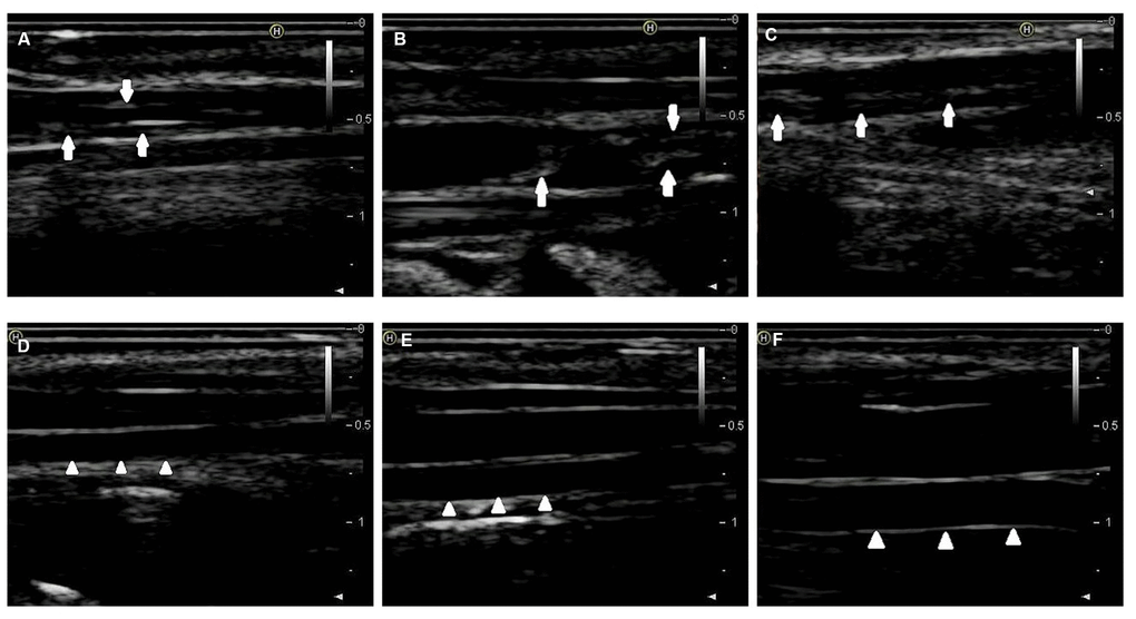2D-ultrasound images of rabbit carotid arteries at the 12th week. (A–C) 2D-ultrasound images reveal that obvious atherosclerotic plaques formed on rabbit carotid arterial intima as the arrows show. (D–F) 2D-ultrasound images demonstrate that carotid arteries intima of rabbits treated with normal chow still maintain smoothness as the arrows show.