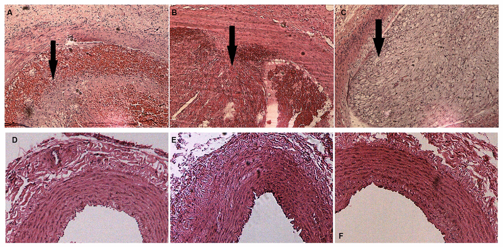 H&E staining of rabbit carotid arteries. (A–C) H&E-stained vasculature shows plaques of varying degrees in rabbit carotid arteries in the AS group as the arrows show, ×40. (D–F) H&E-stained arteries show that no evident abnormal changes are detected in rabbit carotid arteries of the case group, ×40.