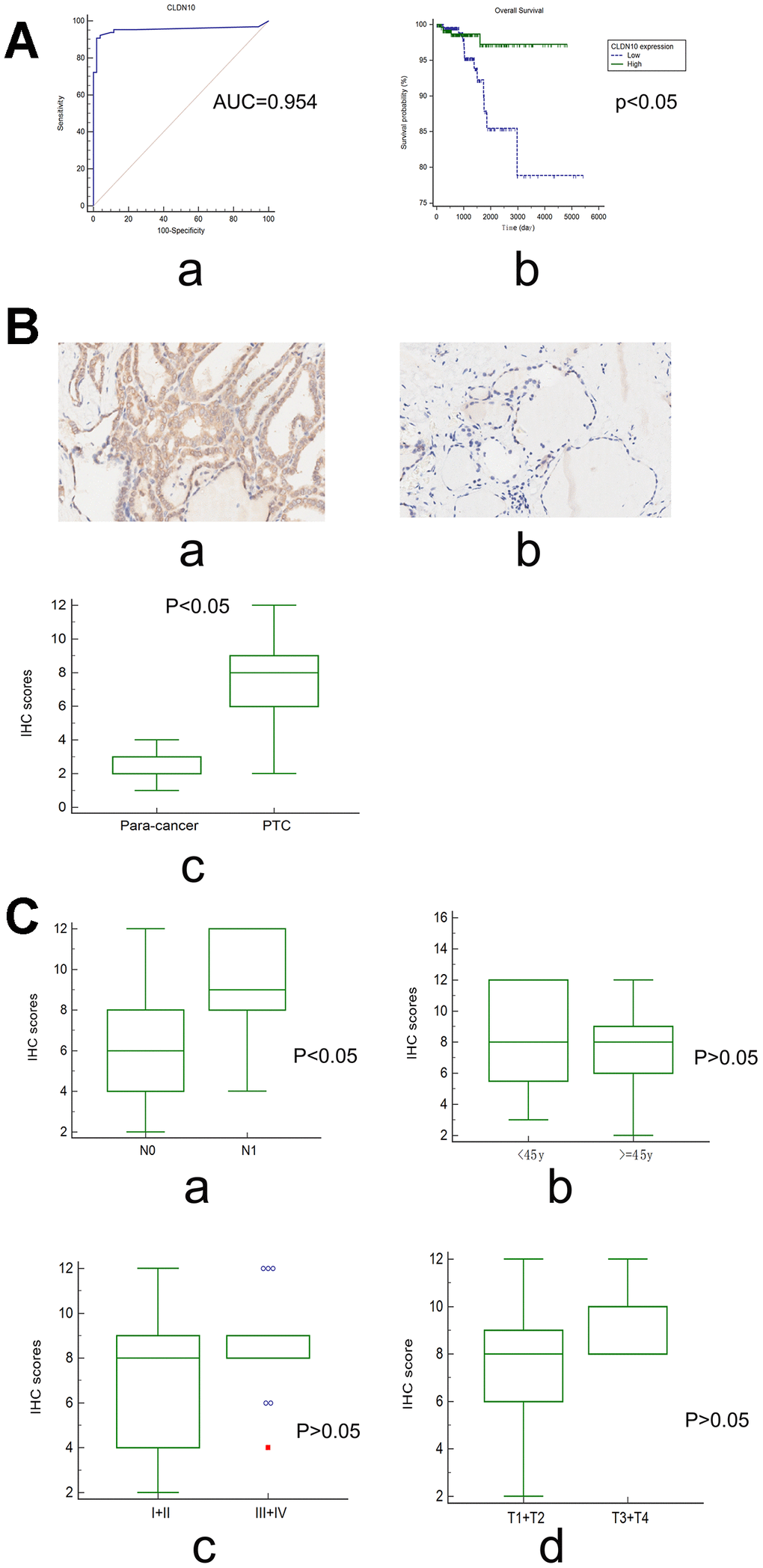 (A) The ROC curve (a) showed that CLDN10 expression can be used as a biomarker distinguishing PTC from normal thyroid tissues (GSE35570; AUC=0.954 (95%CI=0.899-0.984); Specificity=0.9804, Sensitivity=0.9077). The survival curve (b) showed that PTC patients with high CLDN10 expression levels had a longer overall survival time relative to those with low CLDN10 expression ones (PB) CLDN10 expression in PTC tissues and adjacent normal tissues assayed by IHC (×10). (a) cancer tissue; (b) para-cancer tissue; (c) cancer vs normal, PC) The association of CLDN10 protein expression levels with clinical features based on a tissue chip. (a) LNM, N0 vs N1, P=45y, P>0.05; (c) Clinical stage, I+II vs III+IV, P>0.05; (d) T stage, T1+T2 vs T3+T4, P>0.05.