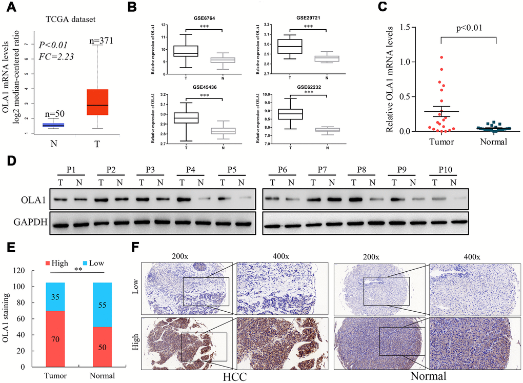 Upregulation of OLA1 in hepatocellular carcinoma (HCC). (A) The Cancer Genome Atlas (TCGA) liver cancer dataset (liver hepatocellular carcinoma) included the messenger RNA (mRNA) expression of OLA1 in HCC tissues (n = 371) and normal tissues (n = 50). (B) OLA1 was highly expressed in HCC tissues compared with normal liver tissues according to the analysis of GEO datasets. GSE6764, tumor, n=35; normal, n=23. GSE29721, tumor, n=10; normal, n=10. GSE45436, tumor, n=95; normal, n=39. GSE62232, tumor, n=81; normal, n=10. (C) Real-time PCR analysis of OLA1 expression in 20 pairs of HCC specimens and corresponding normal liver tissues (PD) OLA1 is upregulated in HCC tissues, as shown by western blot results. (E) OLA1 is upregulated in 70 out of 105 HCC tissues, as shown by IHC. (F) Representative images of OLA1 staining in HCC specimens and normal liver tissues. P, patient; T, tumor; N, normal.