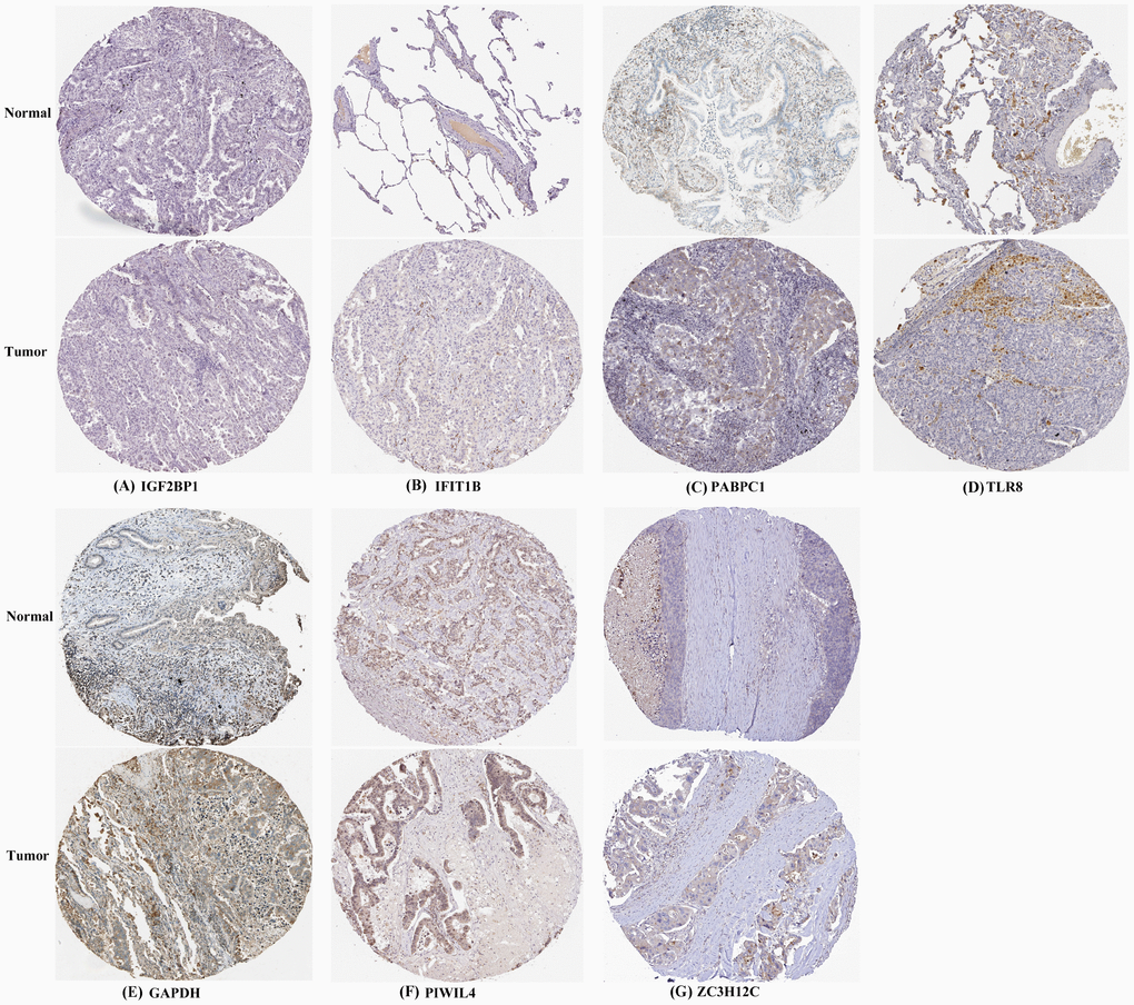 Verification of hub RBPs expression in LUAD and normal lung tissue using the HPA database. (A): IGF2BP1, (B): IFIT1B, (C): PABPC1, (D): TLR8, (E): GAPDH, (F): PIWIL4, (G): ZC3H12C.