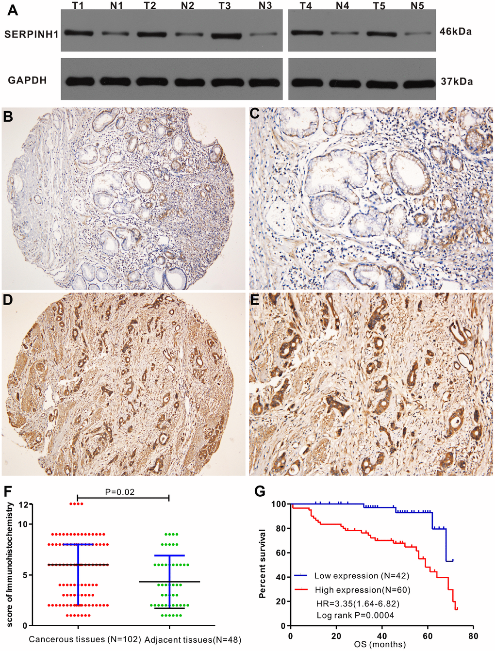 Immunohistochemical analysis of SERPINH1 protein expression in human GC tissues. (A) Immunohistochemical (IHC) analysis shows that SERPINH1 protein levels are significantly higher in five pairs of matched GC tissues compared with the adjacent non-tumor gastric mucosal tissues. (B–E) Representative images show IHC staining of SERPINH1 protein in (B, C) normal gastric mucosal tissues and (D, E) gastric cancer tissues at 100X and 200X magnification, respectively. (F) Comparison of IHC scores show that SERPINH1 protein expression is significantly higher (P=0.02) in gastric cancer tissues (N=102) compared with adjacent non-tumor gastric tissues (N=48). (G) Survival curve analysis shows that GC patients with high SERPINH1 protein levels exhibit poorer OS than patients with low SERPINH1 protein levels (HR=3.35, P=0.0004).