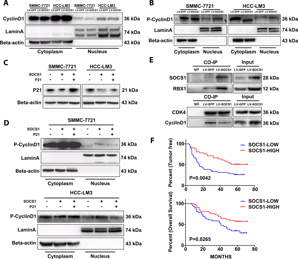 The stability of CyclinD1 and CDK4 in the nucleus limits the cell cycle progression of the tumour. (A) The amount of total CyclinD1 in the nucleus is not upregulated. (B) Effective reduction in CyclinD1 levels in the nucleus. (C, D) P21 can reduce the levels of phosphorylated CyclinD1 in the nucleus and stabilize its CyclinD1 binding to CDK4. (E) Co-IP confirmed that SOCS1 recruited ubiquitin and reduced the stability of CyclinD1/CDK4 complexes. (F) The high level of SOCS1 expression indicates low recurrence and better prognosis in patients with HCC.