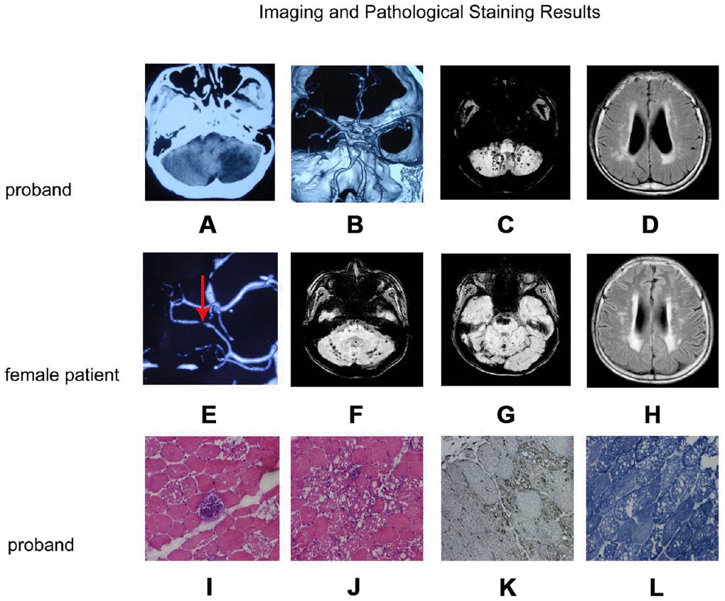 Imaging and pathological staining results. (A–D) and (E–H) are the imaging result of the proband and the female patient, respectively. (I–L) are the results of muscle tissue staining of the proband. (A) Craniocerebral CT shows left cerebellar infarction; (B) CTA of the brain shows a basilar artery with a fusiform aneurysm; (C) Cerebral MRI SWI shows multiple bleeding focus in both hemispheres of the cerebellum; (D) MRI T2FLAIR images shows multiple ischemic lesions in both lateral ventricles and deep white matter; (E) CTA of the brain shows a localized stenosis of the right posterior cerebral artery; (F, G): MRI SWI shows recurrent cerebellopontine hematoma and multiple micro-hemorrhagic foci of cerebellum and brainstem; (H) Craniocerebral MRI T2FLAIR images shows multiple ischemic lesions in both lateral ventricles and deep white matter; (I, J): H&E staining muscle fibers of proband were slightly different in size, polygonal in shape, and slightly increased in kernel fibers. (K) LAMP2 staining was enhanced in the vacuolar muscle fiber, and the distribution was significant at the margin of vacuolar muscle fiber. (L) NADH staining showed the interphase distribution of two types of fibers, the mesh-like structure in vacuolar fibers was disordered, and the activity of NADH in vacuolar region was absent.