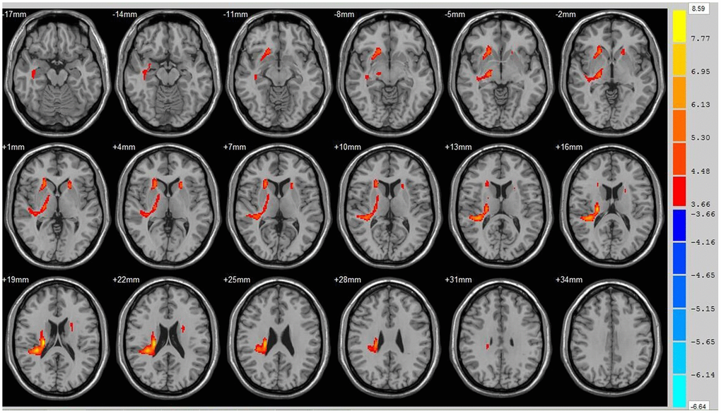 Brain areas with decreased FA value at ICH patients at 1st w. Orange means the brain areas which FA value decreased compared with control group at1st w, Threshold=3.6594.