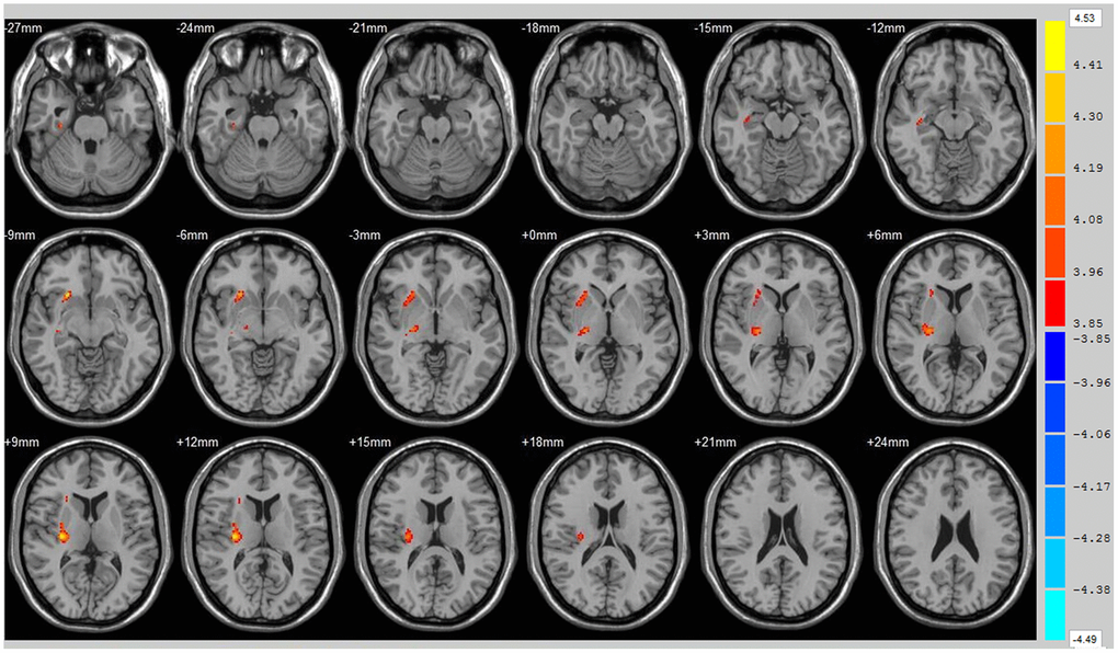 Brain areas with decreased FA value of ICH patients at 12th w. Orange means brain areas with decreased FA value of ICH patients compared with control group at 12th w, Threshold=3.8495.