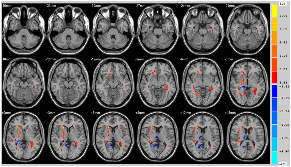 Brain areas with decreased FA value of ICH patients at 1st w and 12th w. Brain areas with increased FA value (Orange) and decreased FA value (Blue) of ICH patients at 12th w compared with 1st w, Threshold=3.6335.
