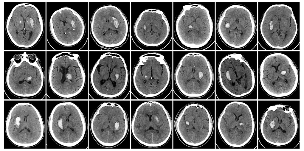 Baseline head CT of ICH patients immediately after admitting hospital.