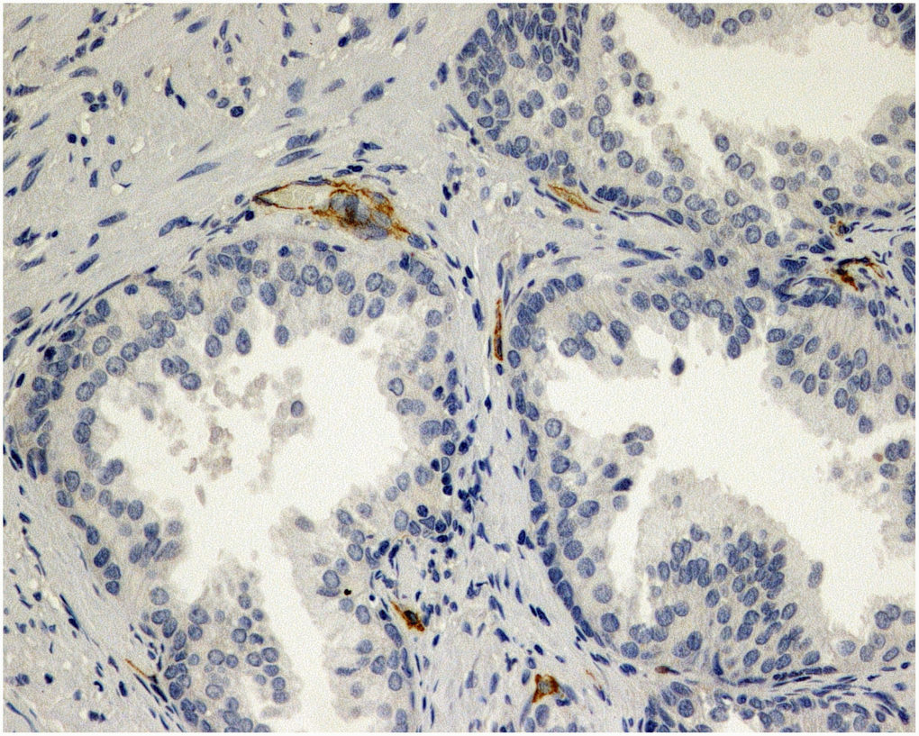 Immunohistochemical evaluation of prostatic tissue of a patient in placebo group - lower expression of MVD (CD34), brown stained spot coloring vessels (x200).