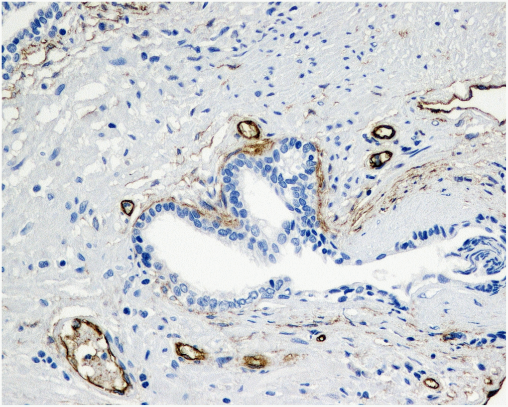 Immunohistochemical evaluation of prostatic tissue of a patient in 5ARI group - higher expression of MVD (CD34), brown stained spot coloring vessels (x200).