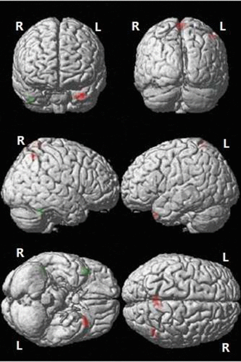 Differences in CBF between the aMCI and NC groups. Green: Decreased CBF in the aMCI compared to NC group; Red: Increased CBF in the aMCI compared to NC group (P 