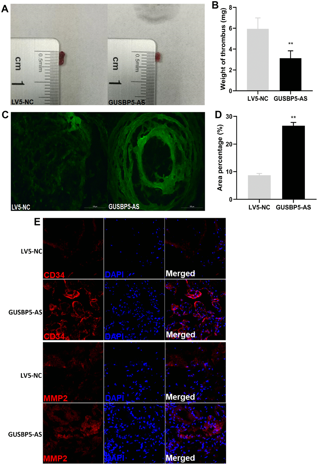 Effects of lncRNA GUSBP5-AS on the treatment of DVT. (A) Representative images of the thrombosis in GFP-GUSBP5-AS-EPC group and LV5-NC group were observed. (B) Weight of the venous thrombi at day 7 after the transplantation. Data are expressed as mean ± SEM (n = 8 mice per group), **P C) Representative images of recruitment of GFP-positive EPCs in DVT (×200). (D) Percentage of green fluorescent area in DVT. **P E) The expression levels of CD34 and MMP2 in thrombosis were detected by immunofluorescence.