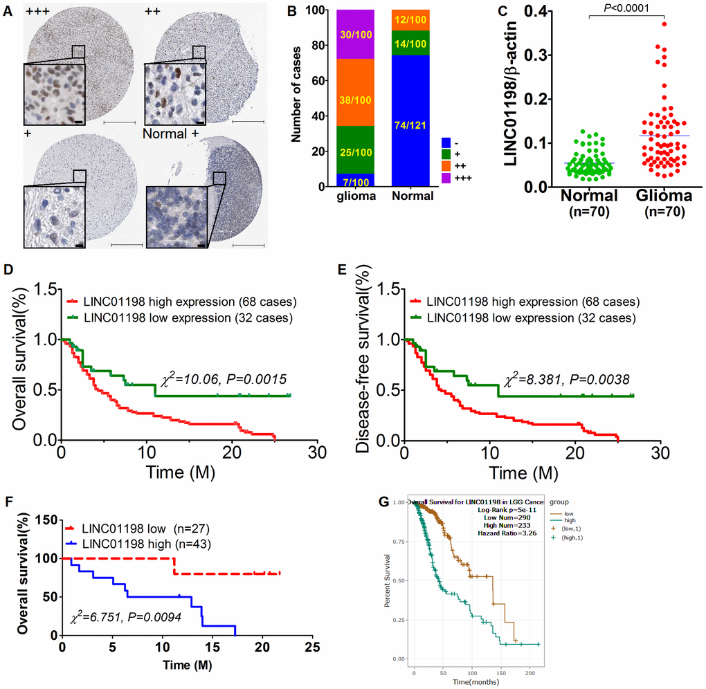 Up-regulated LINC01198 was linked with poor overall prognosis in glioma. (A) heterogeneous expression of LINC01198 in glioma as well as normal brain tissue, with LINC01198 level being markedly varied from strong positive, denoting as +++, to weak positive, denoting as + among different glioma cases, as evidenced by ISH staining. Scale bar, 50μm; scale bar in inset, 5μm. (B) the enumeration of LINC01198 expression evaluated by ISH in glioma and its paired normal controls, totaling 100. (C) qRT-PCR detection of LINC01198 in another independent cohort comprising 70 cases of fresh frozen glioma tissues and its matched normal controls. Two tailed, paired T-test was used to analyze the significant difference (t=8.220, df=69, PD) Overall survival analysis of LINC01198 by Kaplan-Meier survival curve in glioma, totaling 100. Of which, the number of cases detected with high expression of LINC01198 by ISH was 68; the remainder was 32 with low expression of LINC01198. Log-Rank Chi-square was used to analyze the difference of survival (χ2=10.06, P=0.0015). (E) Likewise and incidentally, disease-free survival was also analyzed by Log-Rank Chi-square was used to analyze the difference of survival (χ2=8.381, P=0.0038). (F) Similarly, Overall survival analysis was performed of LINC01198 in 70 cases of fresh frozen glioma tissues, totaling 70 cases. Log-Rank Chi-square was used to analyze the difference of survival (χ2=6.751, P=0.0094). (G) Overall survival analysis of LINC01198 expression data in patients diagnosed with low grade glioma (LGG) derived from TCGA database.
