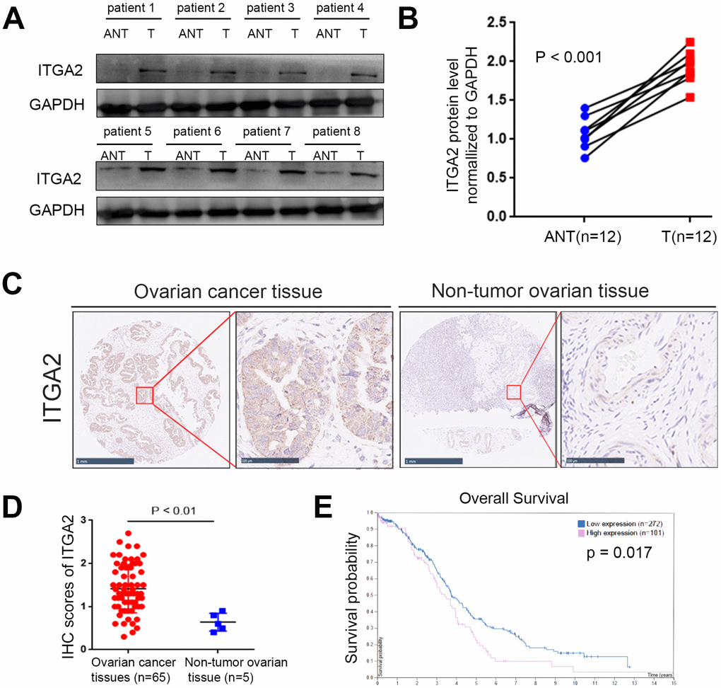 The overexpressed ITGA2 is correlated with poor prognosis in ovarian cancer. (A, B) Western blot assay was conducted to explore the protein expression of ITGA2 in 8 paired primary ovarian cancer tissues (T) and the matched adjacent normal tissues (ANT) of the same patient (A). The quantified proteins expression level of ITGA2 were also shown (B). The P values were shown in the figure. Statistical analyses were performed with D’Agostino and Pearson omnibus normality test. (C) TMA tissue sections were used for ITGA2 IHC staining. The IHC images were shown. The scale bars were shown in the figure. (D) Dot plots to show the IHC score of ITGA2 expression using TMA tissue sections (normal ovarian specimens: n = 5, ovarian cancer TMA specimens: n = 65, P E) The overall survival of ovarian cancer patients was searched by Human Protein Atlas database (P 