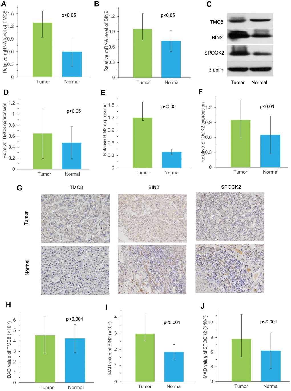 Measurement of TMC8, BIN2 and SPOCK2 at mRNA and protein level in our cohort. (A, B) Relative mRNA levels of TMC8 and BIN2 in 10 HCC samples were both overexpressed compared with matched normal samples by qRT-PCR. (C) Representative western blotting images showed protein expression of TMC8, BIN2 and SPOCK2 were overexpressed in HCC tissue than those in normal liver tissue. (D–F) Western blotting analysis demonstrated that mean greyscale of TMC8, BIN2 and SPOCK2 were all higher in 10 fresh-frozen HCC tissues compared with those in matched adjacent normal liver tissues. (G) Representative immunohistochemical staining images of TMC8, BIN2 and SPOCK2, which were all mainly expressed in the cytoplasm. Original magnification: x200. (H–J) Mean protein expression of TMC8, BIN2 and SPOCK2 in 35 HCC were all significantly higher compared with those in adjacent non-tumour tissue by immunohistochemistry. MAD: mean areal density.