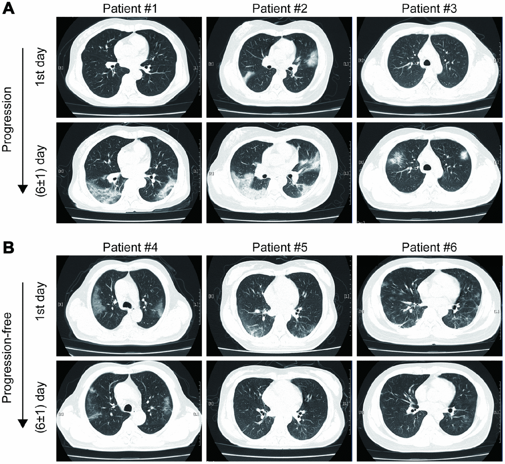 Examples of imaging progression (A) and progression-free (B) in chest CT from COVID-19 patients.