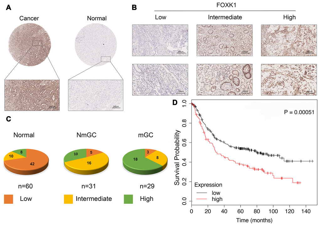 FOXK1 expression is significantly increased in GC metastasis. (A) Representative images of FOXK1 TMA analysis in GC tissues and adjacent tissues. Scale bar, 250 μm. (B) TMA assay of the levels of FOXK1 protein in GC tissues. Representative images of FOXK1 staining in GC tissues from the TMA are shown. Scale bar, 250 μm and 100 μm. (C) Analysis of staining in 60 groups of TMAs. (D) Kaplan-Meier analysis of survival rates of GC patients with high FOXK1 expression and GC patients with low FOXK1 expression.