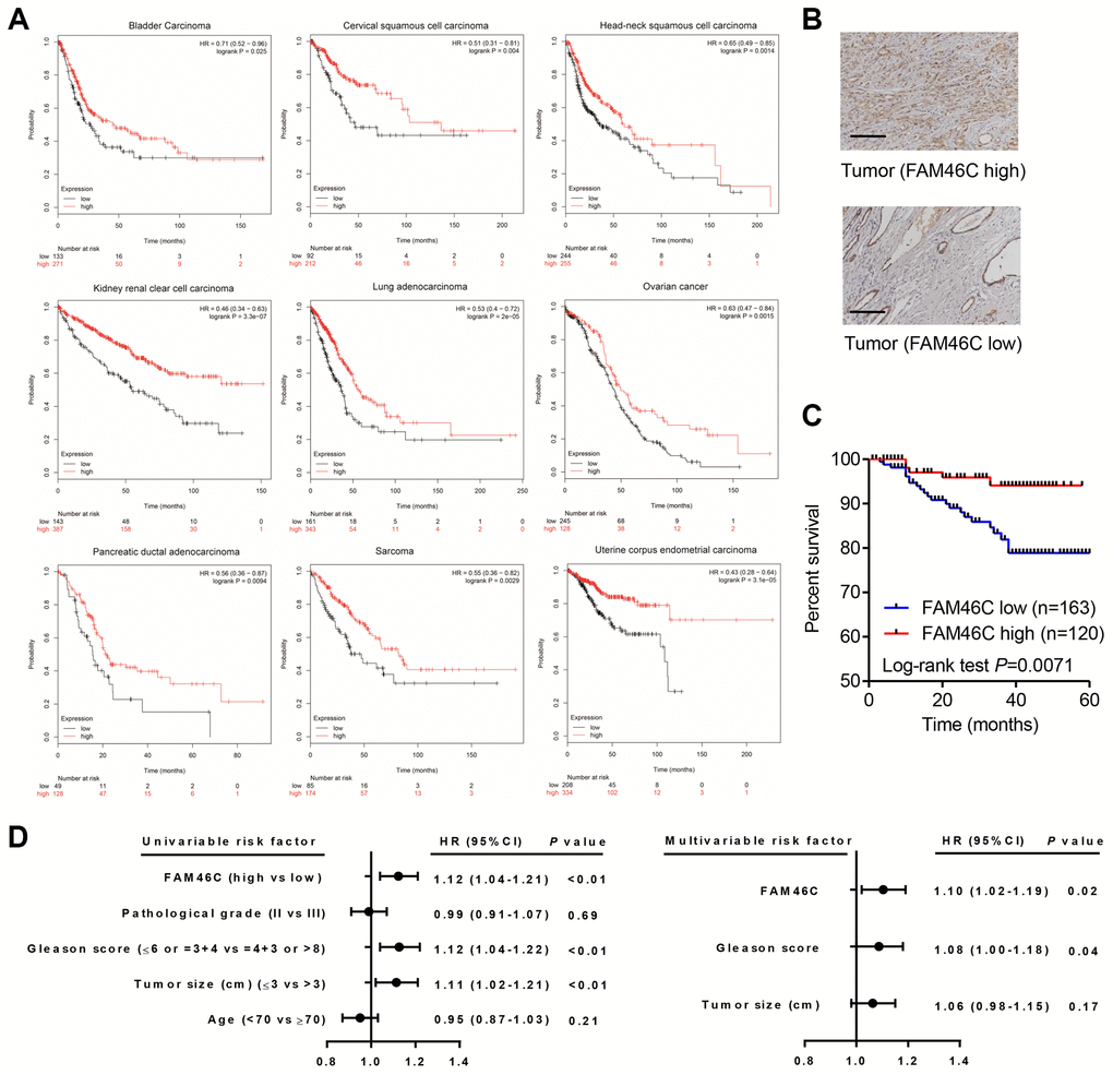 FAM46C was a prognosis factor in prostate cancer patients. (A) FAM46C expression was associated with survival outcome in several cancer types from Kaplan Meier-plotter database. (B) FAM46C protein expression levels in prostate cancer tissues from hospital cohort were measured by immunohistochemistry. Scale bars: 100 μm. (C) Kaplan-Meier curves indicated that overall survival of prostate cancer patients from hospital cohort was associated with FAM46C expression level. (D) Univariate and multivariate analysis of overall survival in prostate cancer patients.