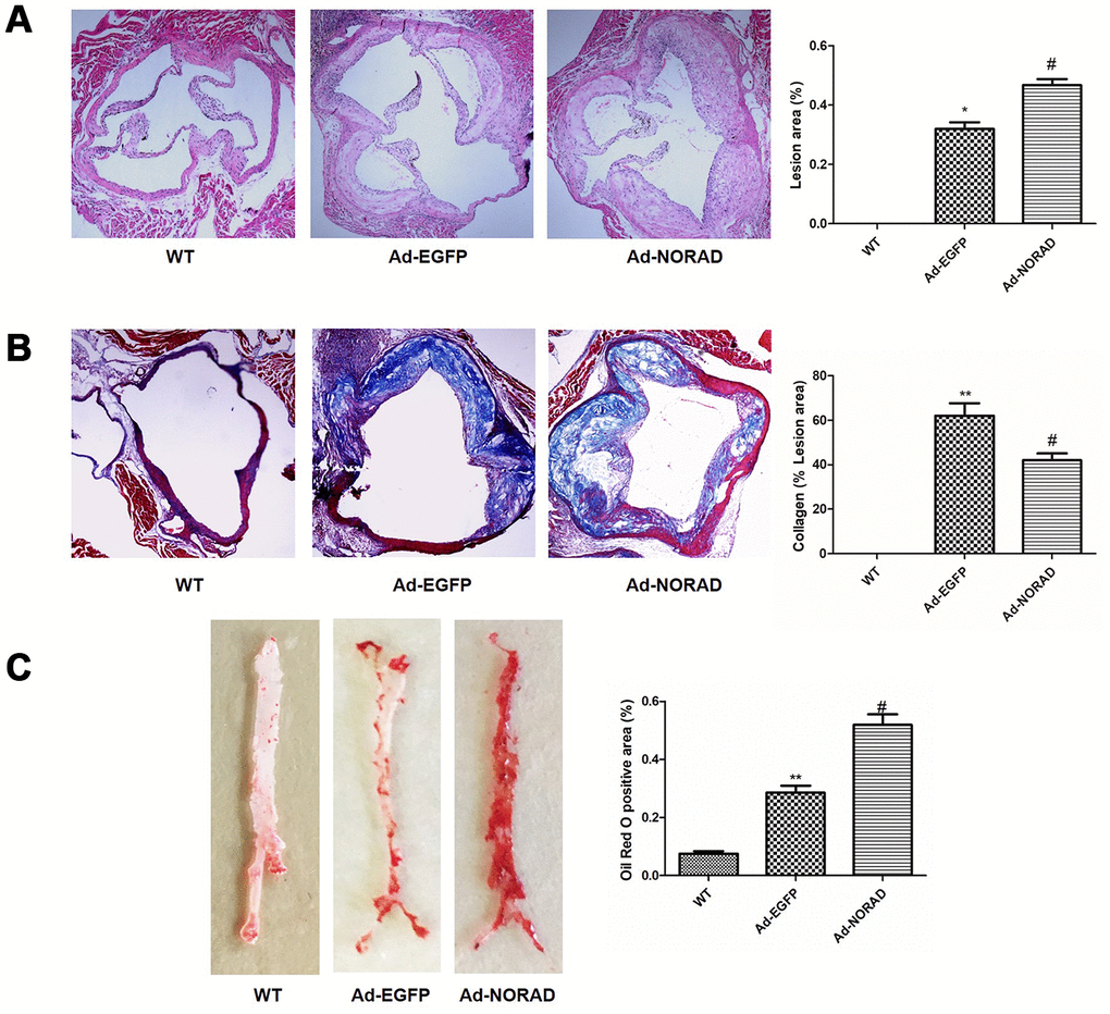 NORAD-knockdown promotes atherosclerosis development in ApoE−/− mice. ApoE−/− mice were given Ad-NORAD or control Ad-EGFP injection after 8 weeks of HFD, and the HFD was maintained for another 8 weeks. C57BL/6 J mice fed with the normal diet were used as the blank WT control group. (A) Representative micrographs and quantification of lesion area in the aortic sinus observed through H&E staining. (B) Representative micrographs and quantification of the collagen fibers area in the aortic sinus observed through Masson staining. (C) Representative en face images of the entire aorta with Oil Red O staining. The atherosclerotic lesion areas were stained red. Oil Red O-positive areas were analyzed with ImageJ. Data were shown as mean ± SD, n = 8. **P *P #P 