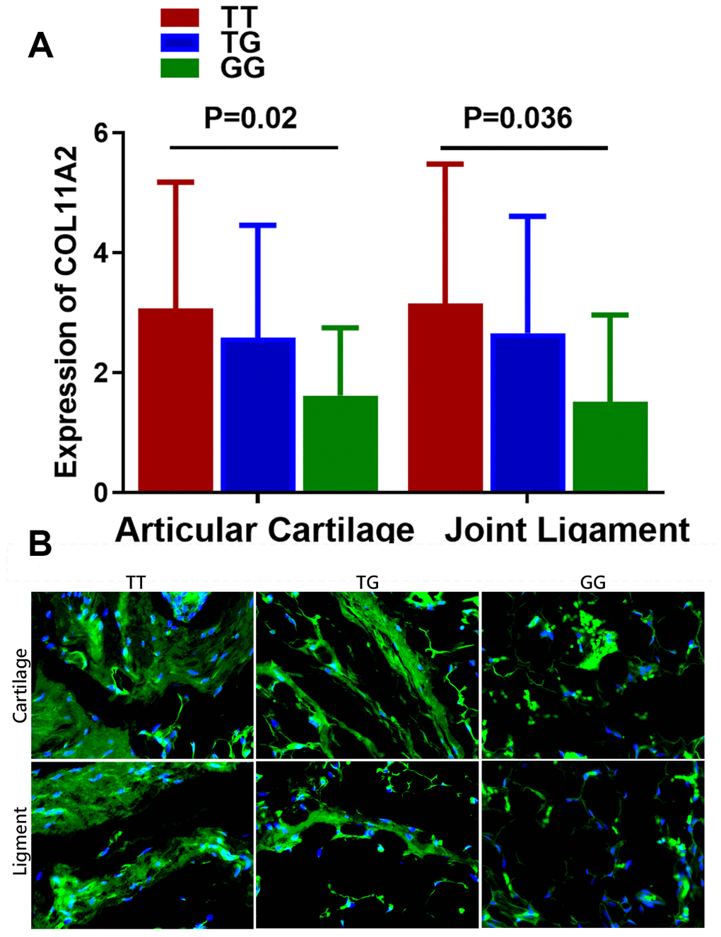 Relationship between the genotype of rs9277935 and COL11A2 expression in DDH joint tissues. (A) DDH Patients with genotype TT have a significantly increased expression of COL11A2 than those with GG (p = 0.02 for articular cartilage; p = 0.036 for joint ligament). (B) Immunofluorescent assay of COL11A2 (green) expression and nucleus (blue) in the cartilage and ligament tissues in DDH patients with different genotypes observed under confocal microscopy.