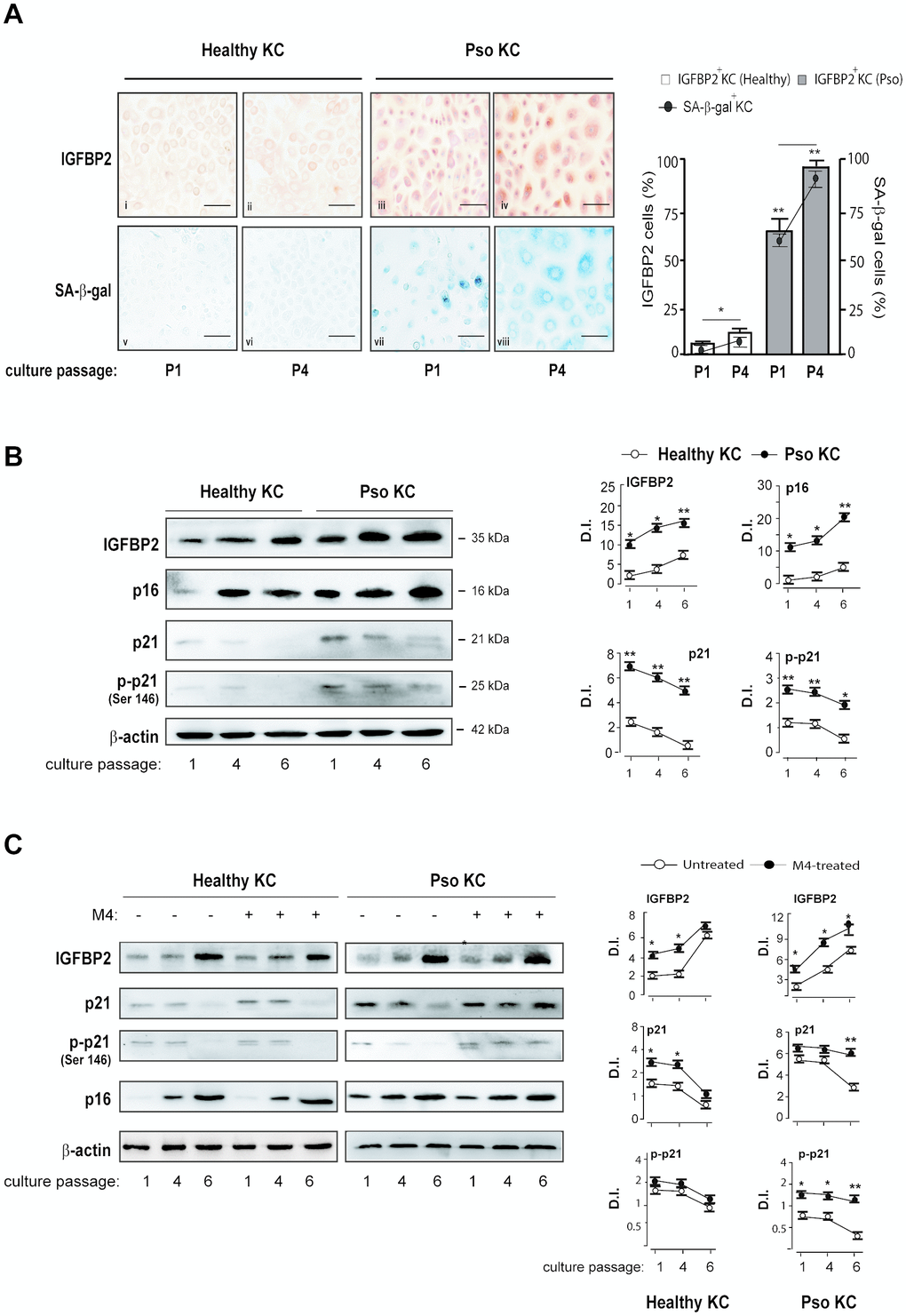 IGFBP2 expression progressively increases during senescence changes in psoriatic KC. (A) Healthy and pso KC were serially subcultured until they undergo senescence, and analysed by immunocytochemistry for the expression of IGFBP2 at two distinct culture passages (P1 and P4) (upper panels). Healthy KC were not counterstained with haematoxylin in order to preserve faint IGFBP2-specific staining (upper panels). The activity of senescence-associated β-galactosidase (SA- β-gal) was detected by colorimetric staining (blue) in healthy and pso KC cultures at passage P1 and P4. Data are representative of three independent experiments performed on different healthy (n = 3) and psoriatic (n = 3) donors. Bars, 50 μm. The graph shows the means of the percentage of IGFBP2 positive cells or SA- β-gal positive cells ± SD, counted in two adjacent fields. (B, C) WB analysis was performed on total protein lysates from healthy and pso KC at different serial passages of culture, left untreated (B) or M4-treated (C), to detect IGFBP2, p16, p21 and p-p21 expression. β-actin was used as loading control. Graphs represent the means of the densitometric intensity (D.I.) ± SD of the bands obtained from three different WB experiments. *p ≤ 0.05, **p ≤ 0.01, as calculated by unpaired Student’s t test, comparing healthy and pso KC groups, or M4-treated and untreated groups.