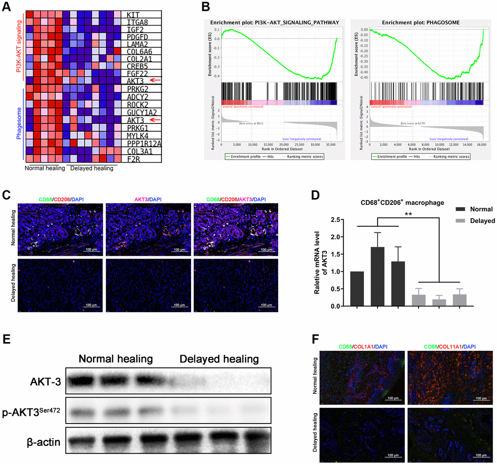 Loss of AKT3 in M2 macrophages inhibited extracellular COL1A1 and COL11A1 expression. (A) GSEA showed that negatively enriched genes were associated with PI3K-AKT signaling and phagosomes in delayed cutaneous wound tissue. (B) Heatmap of the top 10 genes related to PI3K-AKT signaling and phagosomes; AKT3 was downregulated in both functional enrichment sets in the delayed cutaneous wound tissue. (C) Immunofluorescence of cutaneous wound tissue (n = 6). CD68- (green) and CD206-(red) positive M2 macrophages were reduced in the delayed cutaneous wound tissue. AKT3 (pink) was decreased in the M2 macrophages. (D) qRT-PCR showed decreased AKT3 mRNA expression in the delayed cutaneous wound tissue-derived M2 macrophages. (E) Western blotting verified the reduction and loss of AKT3 in M2 macrophages from delayed cutaneous wound tissue. (F) Immunofluorescence of COL1A1 and COL11A1 in CD68-positive macrophages in cutaneous wound tissue. (a) Decreased CD68-positive macrophage infiltration and COL1A1 protein expression were observed in delayed cutaneous wound tissue. (b) Decreased COL11A1 protein expression also accompanied the reduced CD68-positive macrophage infiltration. All the experiments were repeated at least three times.