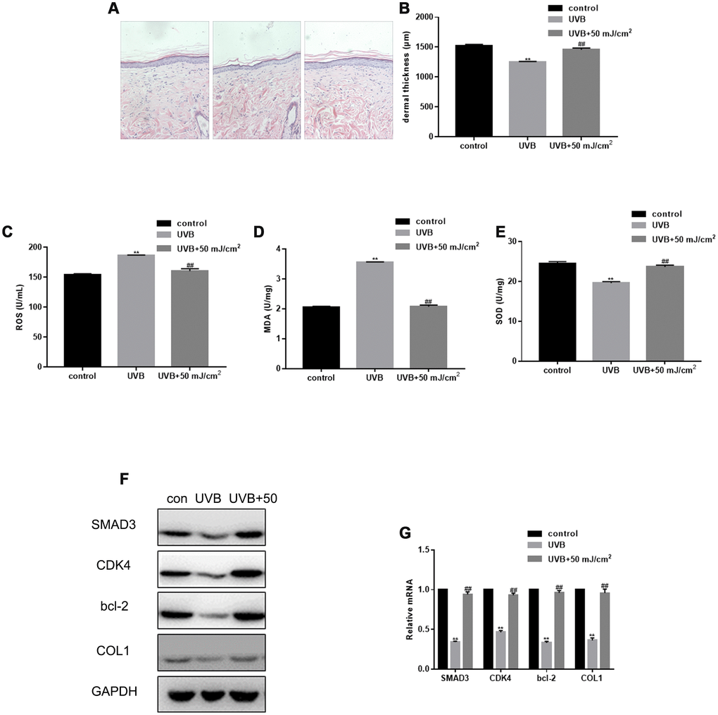 Therapeutic effect of CO2 lattice laser on photoaging of rat skin. (A) HE staining of skin structures in control, UVB irradiation, and CO2 lattice laser treatment groups. (B) Dermal thickness in control, UVB irradiation, and CO2 lattice laser treatment groups. Data are shown as mean ± SEM;** P## PC) ROS production analyzed by ELISA in cells irradiated by control, UVB, or UVB and 50 mJ/cm2 CO2 Lattice Laser. Data are shown as mean ± SEM.** P## PD) ELISA of MDA in cells irradiated by control, UVB or UVB and 50 mJ/cm2 CO2 Lattice Laser. Data are shown as mean ± SEM.** P## PE) ELISA of SOD in cells irradiated by control, UVB or UVB and 50 mJ/cm2 CO2 Lattice Laser. Data are shown as mean ± SEM.** P## P(F, G) Expression of SMAD3, CDK4, Bcl-2, and COL1 analyzed by western blotting and RT-PCR in control, si-SMAD3 or si-SMAD3 and 6.25 mJ/cm2 CO2 Lattice Laser groups. Data are shown as mean ± SEM.** P## P