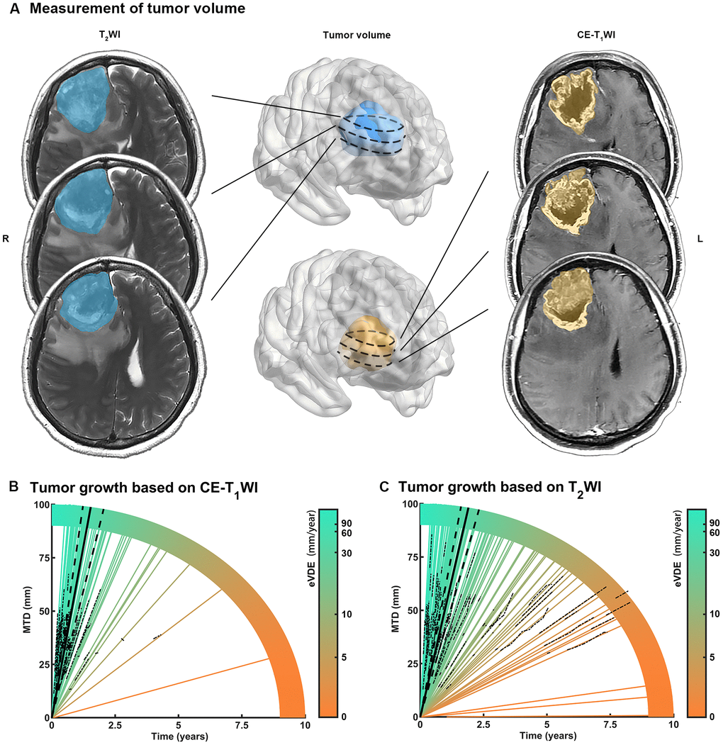 Measurement of tumor growth rate in high grade gliomas (HGGs). (A) Mean tumor diameter (MTD) was calculated for tumor volume measured by preoperative MR images. (B, C) Tumor growth trajectories for each patient (colored lines) were aligned with MTD evolution with time (dotted lines). The equivalent velocity of diameter expansions (eVDEs), which represented the slope of tumor growth trajectory, estimated on T2WI (eVDE, 51.6 mm/year; 95% confidence interval [CI], 41.5-61.0 mm/year) and contrast-enhanced T1-weighted image (CE-T1WI) (eVDE, 64.3 mm/year; 95% CI, 47.8-90.7 mm/year) were shown in black lines.