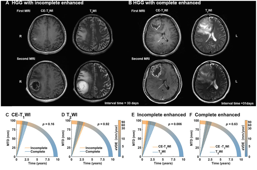 Tumor growth rate in different contrast enhancement (CE) type. (A, B) The longitudinal contrast-enhanced T1-weighted image (CE-T1WI) and T2WI MR-images with incomplete enhanced and complete enhanced high-grade gliomas (HGGs), respectively. (C, D) For HGGs with two or more CE- T1WI MR images (n = 54), equivalent velocity of diameter expansions (eVDEs) in different CE type based on T2WI (represented tumor entity) and CE-T1WI (represented tumor enhanced area) showed no significant difference (p > 0.05). (E, F) HGGs with incomplete enhanced showed significant faster eVDEs in tumor enhanced area than tumor entity (p = 0.006). However, HGGs complete enhanced showed no significant difference in eVDEs between tumor enhanced area and tumor entity (p = 0.63).