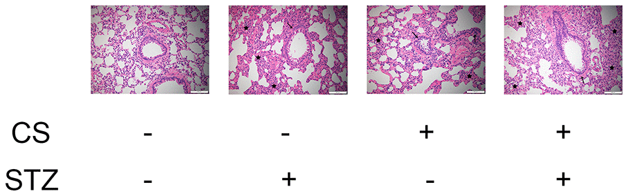 CS-induced COPD and streptozotocin-induced diabetes damaged the lungs of rats. Hematoxylin and eosin staining of bronchioles from control, COPD, diabetic and COPD diabetic rats. →: Bronchiole with smooth muscle hyperplasia, globe cell metaplasia and inflammatory cell infiltration; ★: Hyperplastic parenchyma with inflammatory cell infiltration.