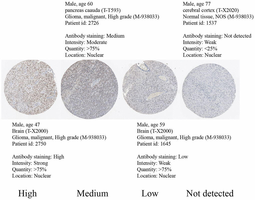 Immunohistochemical staining of glioma tissue taken from the Human Protein Atlas showing SOX6-negative tissue (male, age 77) and high SOX6 (male, age 47), medium SOX6 (male, age 60), and low SOX6 (male, age 59) expressing glioma tissue.