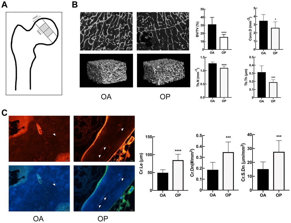 OP group showed deteriorated bone microstructure and more microdamage than OA. (A) The position of the samples for micro-CT and microdamage analysis within the femoral head. (B) Representative micro-CT images of tibias, and comparison of the microstructure parameters between two groups. (C) Fluorescent images and comparison of microdamage (white arrow head) in the OA group and OP group (x 200). The data are expressed as the means ± SD (n = 10 in each group). *P