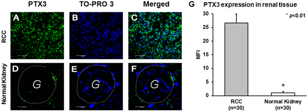 PTX3 expression in neoplastic (A-C) and normal renal tissues (D-F) by confocal microscopy and quantification of specific fluorescence (G).