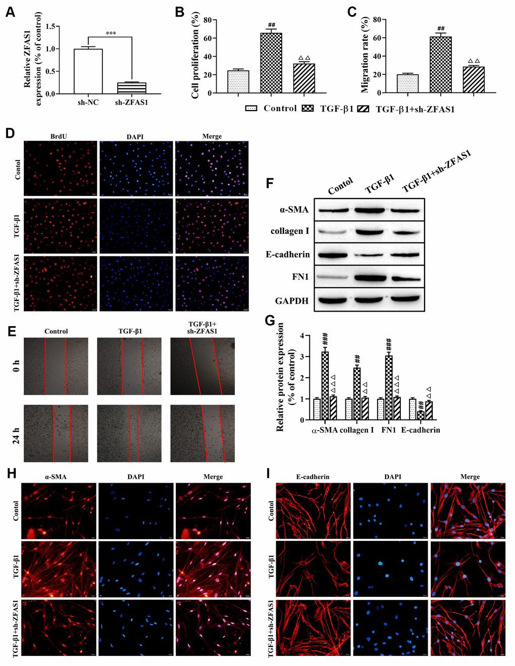Knockdown of lncRNA ZFAS1 inhibits the FMT process in TGF-β1-induced HFL1 cells. (A) The expression of lncRNA ZFAS1 in HFL1 cells transfected with lncRNA ZFAS1 shRNA was determined by RT-qPCR; (B–D) BrdU staining was applied to test cell viability; (C–E) The migration ability of HFL1 cells was measured by wound healing assay; (F, G) Western blot was performed to detect the expression levels of E-cadherin, collagen I, FN1 and the FMT marker α-SMA; (H, I) Immunofluorescence staining was applied to evaluate the expression of α-SMA and E-cadherin in HFL1 cells. ***P##P###PΔΔPΔΔΔP