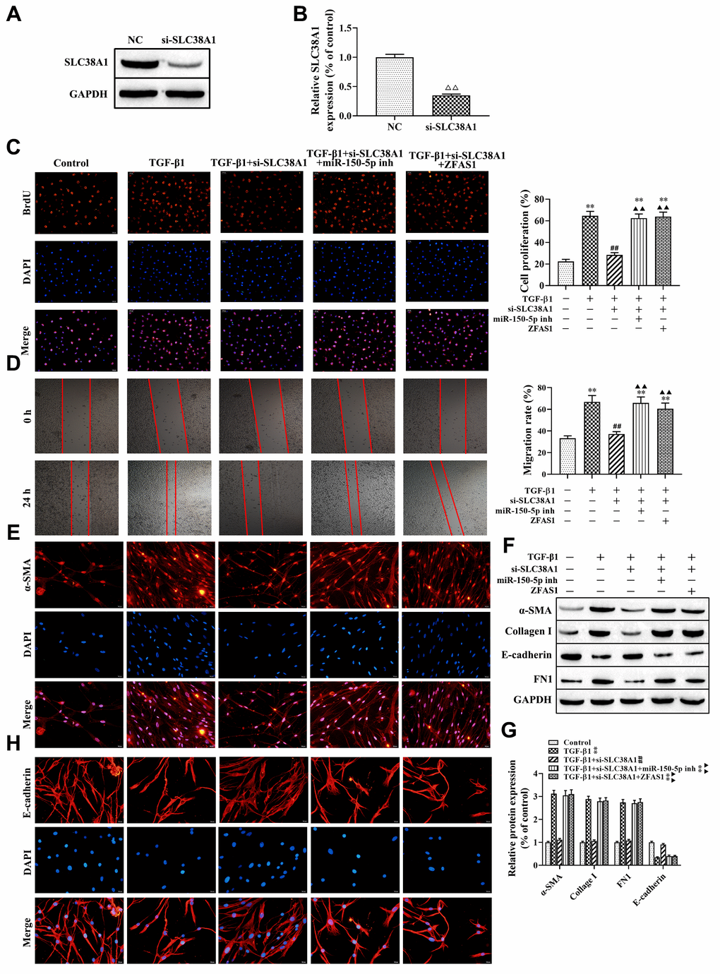 lncRNA ZFAS1 regulates FMT activation via the miR-150-5p/SLC38A1 axis in HFL1 cells. (A, B) Western blot was performed to detect the expression of SLC38A1 in HFL1 cells; (C) BrdU staining was applied to analyze cell viability; (D) Wound healing assay was used to detect the migration of HFL1 cells; (E, H) The expression levels of α-SMA and E-cadherin in HFL1 cells were measured by immunofluorescence staining; (F, G) Western blot was performed to detect the expression levels of E-cadherin, collagen I, FN1 and α-SMA. ΔΔP**P##P▲▲P
