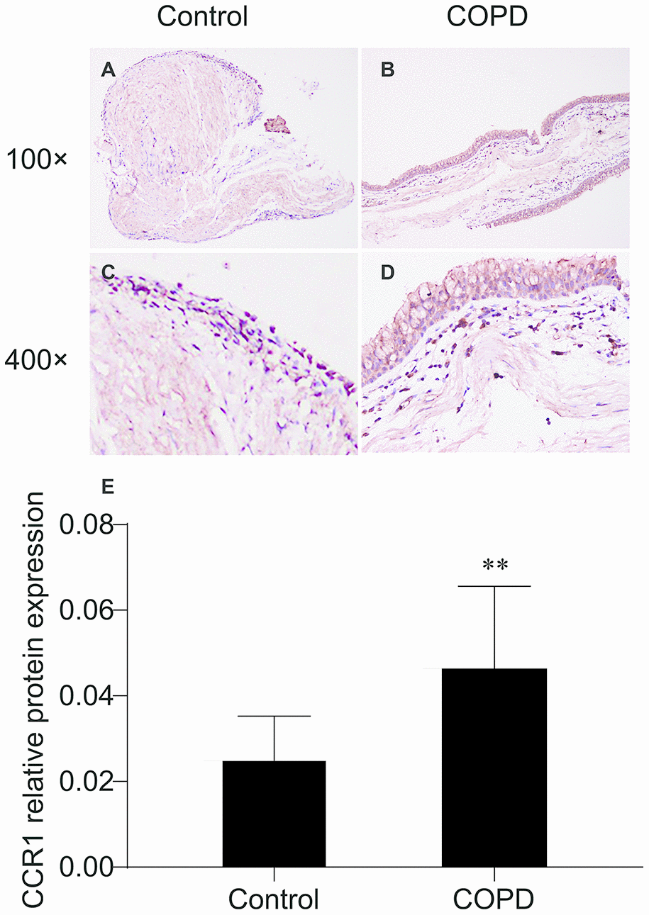 Immunohistochemistry of CCR1 in the bronchial mucosa of patients with COPD and control. (A) CCR1 expression (brown staining) from a patient with COPD. (B) CCR1 expression (brown staining) from a control. (C) Representative CCR1 expression (brown staining) from a patient with COPD. (D) Representative CCR1 expression (brown staining) from a control. (E) Quantification of the histochemistry results, expressed as integral optical density of brown staining in the different views of patients with COPD and controls. The results are presented as mean ± SEM. Original magnification ×200 or ×400. ** p 