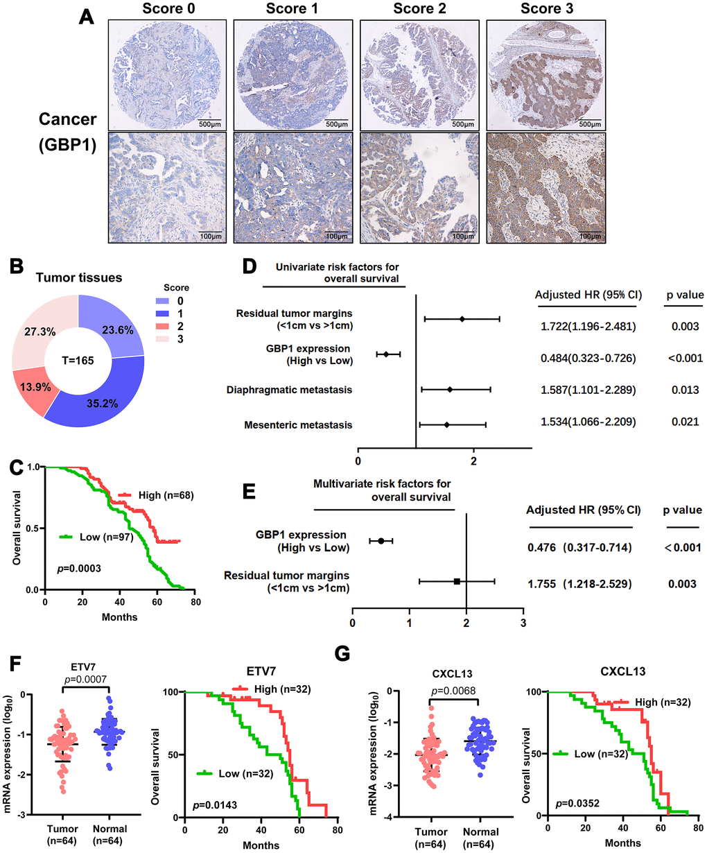 Levels of GBP1 and ETV7 expression correlated with overall survival in HGSOC. (A) Representative images of GBP1 expression in HGSOC tissues, visualized at 40× and 200× magnification. (B) Distribution of the immunoreactive score (IRS) in an HGSOC TMA. (C) Kaplan-Meier survival curve with log-rank analysis of overall survival showed statistical significance between the curves of patients with high GBP1 expression and those with low GBP1 expression (log-rank test, p=0.0003). (D) Univariate analysis was performed in 165 HGSOC patients. All bars correspond to 95% confidence intervals. (E) Multivariate analysis was performed in 165 HGSOC patients. All bars correspond to 95% confidence intervals. (F–G) Expression levels of ETV7 and CXCL13 were measured in HGSOC tissues compared with controls. Moreover, Kaplan-Meier method indicated the prognostic significance of ETV7 and CXCL13.