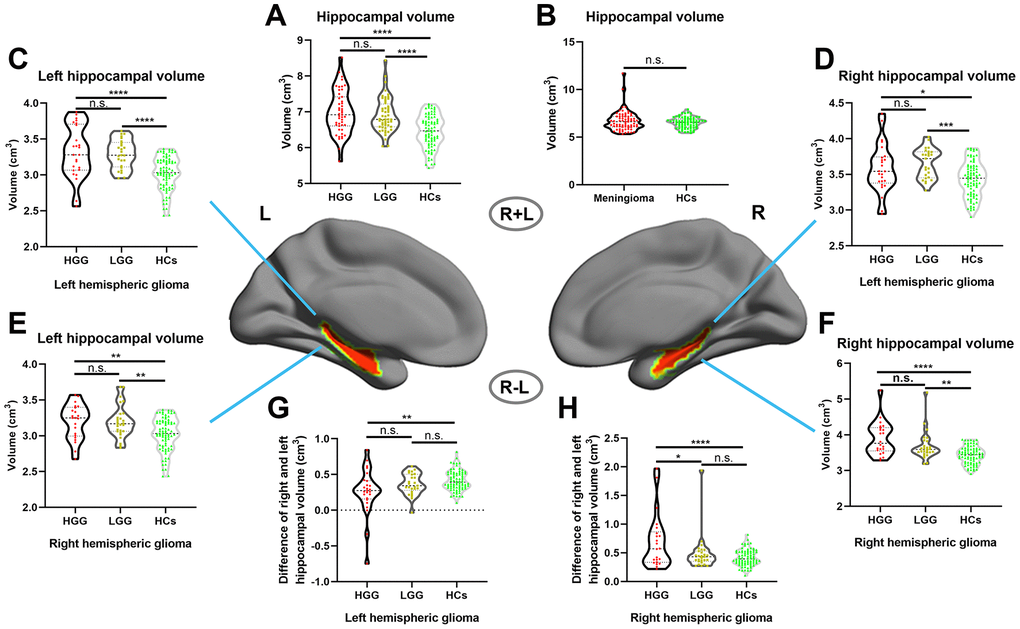 Increased hippocampal volume in glioma patients with ROI-based analysis. (A) Hippocampal volume significantly increased in both the HGG and LGG groups compared to HCs (one-way ANOVA with Bonferroni correction, **** p B) No significant difference in hippocampal volume between meningioma patients and HCs (two-sample t test, p = 0.24). (C, D) Right and left hippocampal volume significantly increased in left hemispheric glioma (including left LGG and left HGG) compared to HCs (one-way ANOVA with Bonferroni correction, * p E, F) Right and left hippocampal volume significantly increased in right hemispheric glioma (including right LGG and right HGG) compared to HCs (one-way ANOVA with Bonferroni correction, ** p G, H) For right and left hemispheric high-grade glioma patients, there was a significant increase in the ipsilateral hippocampal volume relative to the contralesional hippocampal volume in the HGG group compared to the LGG and HCs groups (one-way ANOVA with Bonferroni correction, ** p .