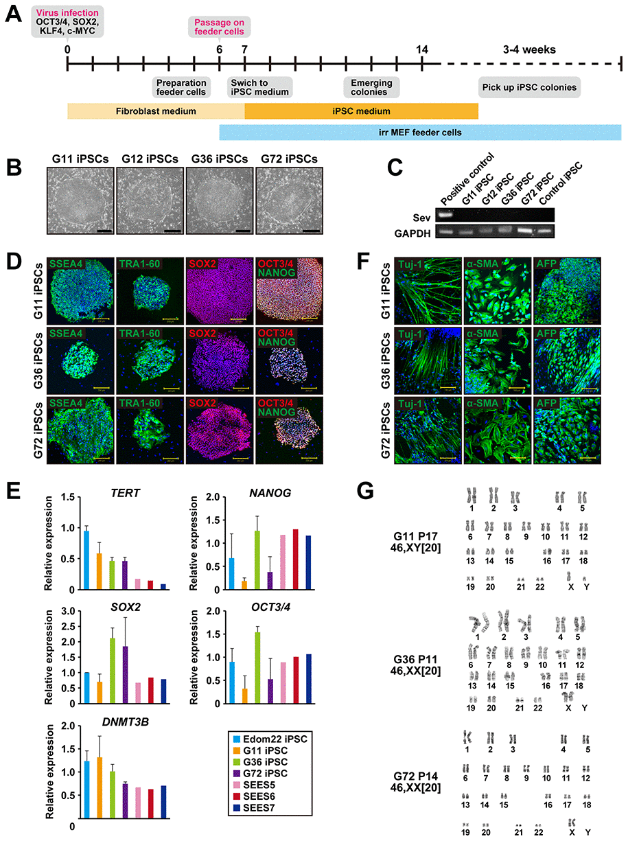 Generation of iPSCs from fibroblasts of patients with Gorlin syndrome. (A) Protocol for iPSC generation. (B) Phase-contrast microphotographs of Gln-iPSCs (G11, G12, G36, G72). (C) RT-PCR analysis of the Sendai virus. (D) Immunocytochemical analysis of Gln-iPSCs using antibodies to NANOG, OCT4/3, SOX2, SSEA4, and TRA1-60. (E) Expression of the endogenous TERT, NANOG, SOX2, OCT4/3, and DNMT3B genes. (F) in vitro differentiation of Gln-iPSCs into three germ layers. Immunocytochemical analysis of Gln-iPSCs using antibodies to Tuj-1, α-smooth muscle actin (SMA) and α-fetoprotein (AFP). Expression of the endogenous TERT, NANOG, SOX2, OCT4/3, and DNMT3B genes. (G) Karyotypes of Gln-iPSCs at the indicated passage number. Numbers in brackets indicate the number of cells analyzed.