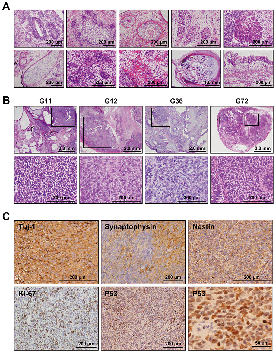Medulloblastoma in Gln iPSC-teratoma. (A) Histology of teratoma generated by Gln-iPSCs. Upper panels from left to right: ectodermal glia and neuroepithelium; epidermis with hair follicles; epidermis with keratinization; ganglia; hepatocytes. Lower panels from left to right: cartilage; glomerulus-like structure; capillary vessels; bone and cartilage; intestinal epithelium. (B) Medulloblastomas were generated in the teratomas by Gln-iPSCs (G11, G12, G36, G72). Upper panels: low power view of the teratomas. Lower panels: high power view of medulloblastoma parts. Medulloblastomas were shown in the squares of the upper panels. (C) Immunohistochemical analysis of medulloblastoma using antibodies to Tuj-1, synaptophysin, nestin, Ki-67, and p53.