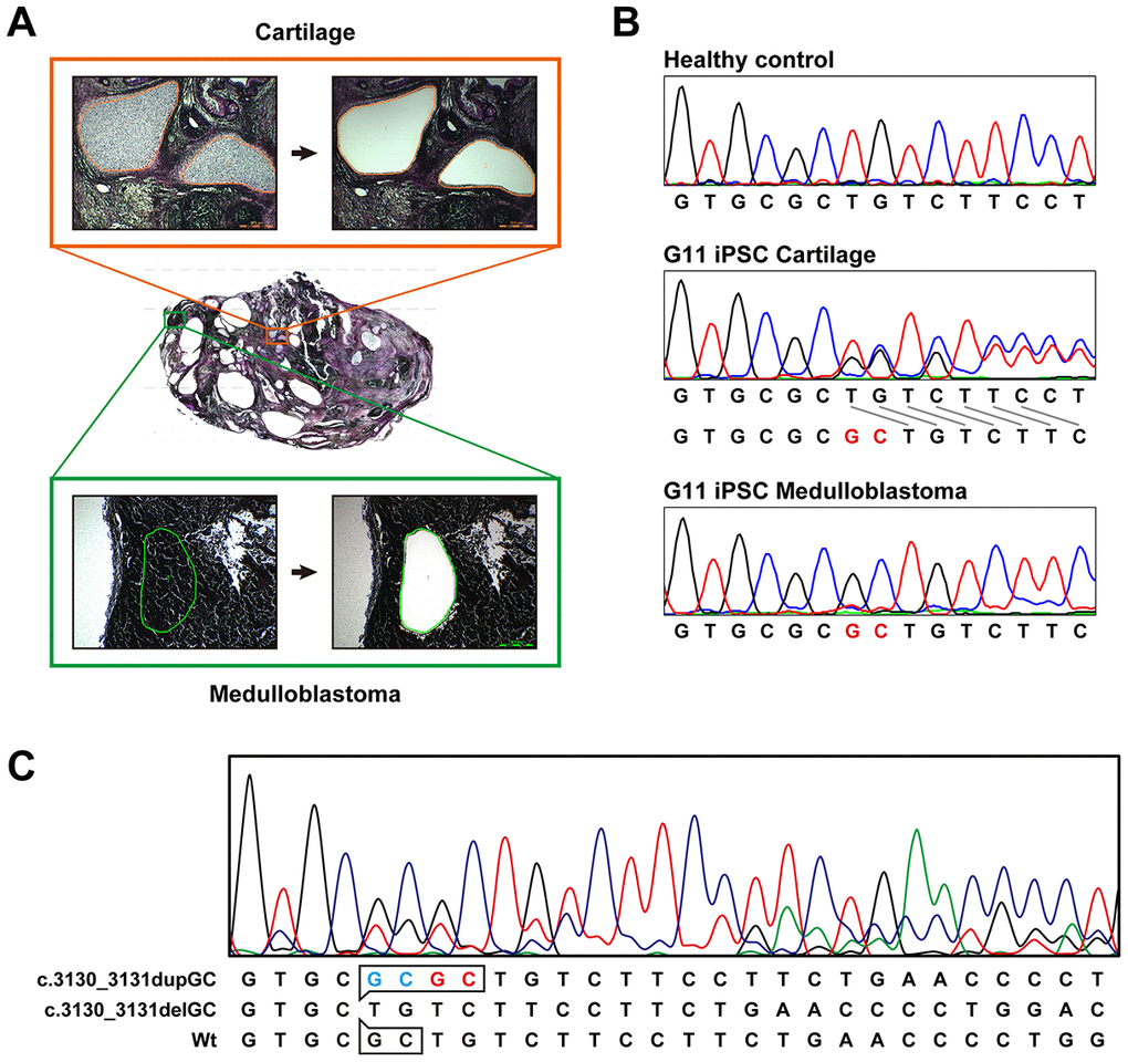 Sequence analysis of the PTCH1 gene in medulloblastoma. (A) Microdissection of medulloblastoma and cartilage. Genomic DNA was isolated from the microdissected medulloblastoma and applied to direct sequence analysis. Genomic DNA was also isolated from the cartilage for comparison. (B) Direct sequence analysis of genomic DNA from unaffected donor (control), G11-iPSC cartilage and G11-iPSC medulloblastoma. G11-iPSC cartilage had a duplication of “GC” (shown in red), and G11-iPSC medulloblastoma showed LOH of the PTCH1 gene. (C) Direct sequence analysis of genomic DNA from G12-iPSC medulloblastoma. Sequences at the top and middle represent a germline mutation (c.3030