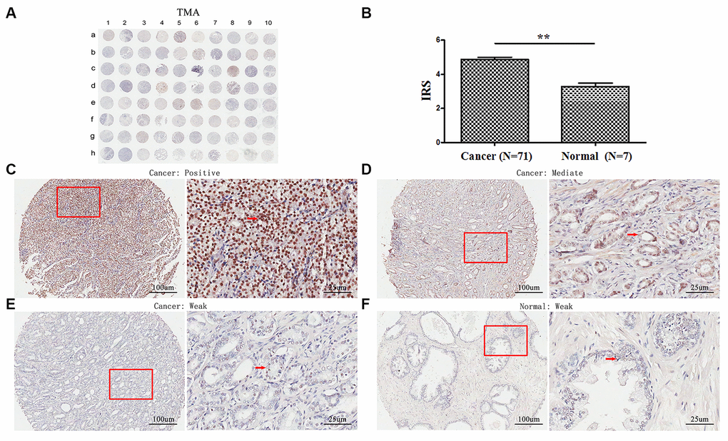 Immunohistochemical staining for TopBP1 expression in prostate cancer and paracancerous tissues of our TMA sample. (A) A full view of the immunohistochemistry staining for TopBP1 in TMA. (B) The immunoreactivity scores (IRS) of TopBP1 in prostate cancer (n=71) and in paracancerous tissues (n=7) Data were presented as Mean ± SEM. *p = 0.002. (C–E) The immunohistochemistry staining indicated that TopBP1 immunostainings mainly occurred in the cytoplasm of PCa and the intensity of TopBP1 immunostainings was positive (C), intermediate (D), and weak (E). (F) Weak staining of TopBP1 in paracancerous tissues.