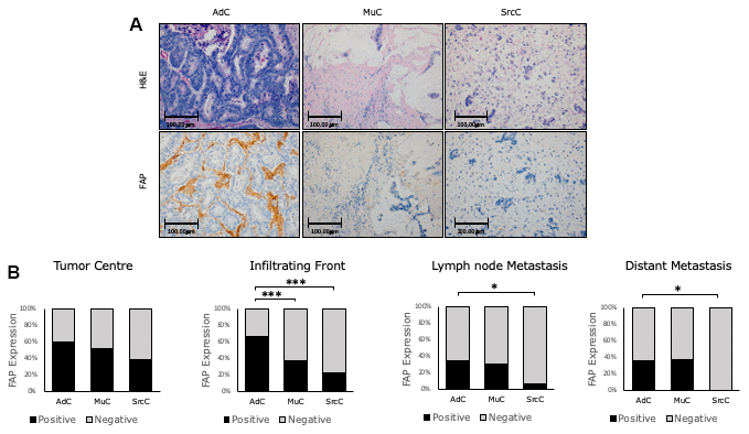 Altered expression of fibroblast activation protein-α (FAP) in ...