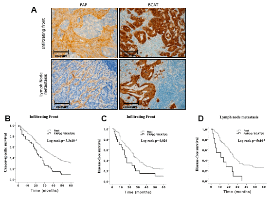 Immunohistochemical FAP and nuclear BCAT staining in the infiltrating front and in lymph node metastasis. (A) FAP was expressed in CAFs that penetrated within the body of lymphatic nodes. Nuclear and adjacent cytoplasmic BCAT staining represents BCAT signalling translocation from membrane to nucleus (x200). (B, C) Kaplan-Meier curves and univariate Log-rank test showed that simultaneous expression of FAP in CAFs and nuclear BCAT in AdC cells from the infiltrating front significantly associated with worse 5-year cancer-specific (CSS) and disease-free (DFS) survival of AdC patients. (D) The same combination in lymph node metastases was significantly associated to 5-year DFS.