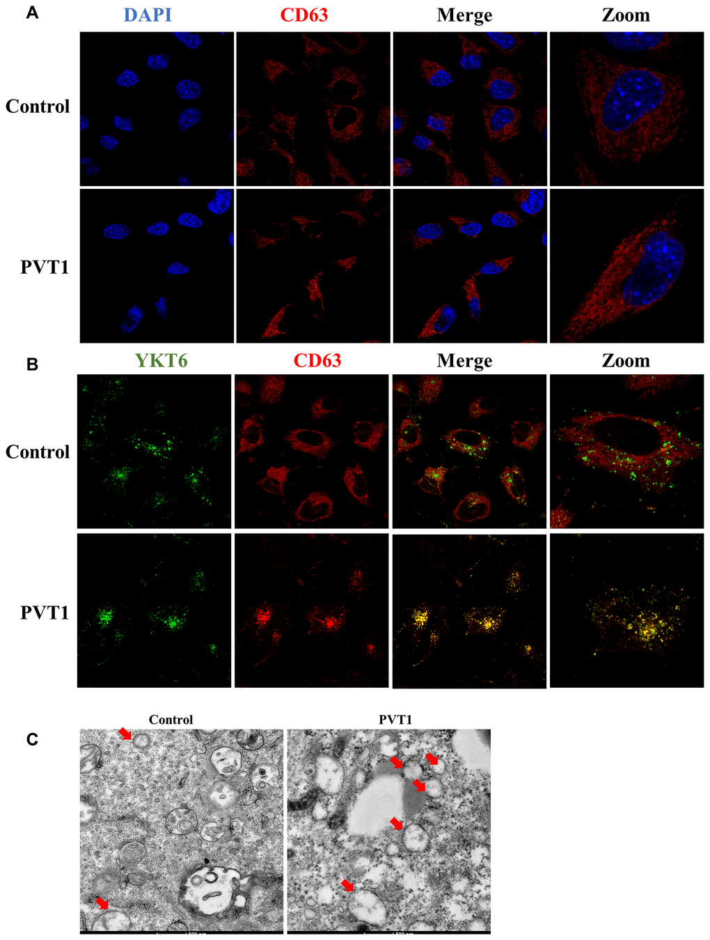 PVT1 promotes the movement of MVBs towards the plasma membrane. (A) Analysis of CD63 (red) in PVT1-overexpressing HS766T cells, as determined by confocal microscope. Nuclei were labeled with DAPI (blue). (B) Analysis of YKT6 (green) and CD63 (red) in PVT1-overexpressing HS766T cells, as determined by confocal microscope. (C) Exosomes in PVT1-overexpressing HS766T cells, as determined by electron microscope.