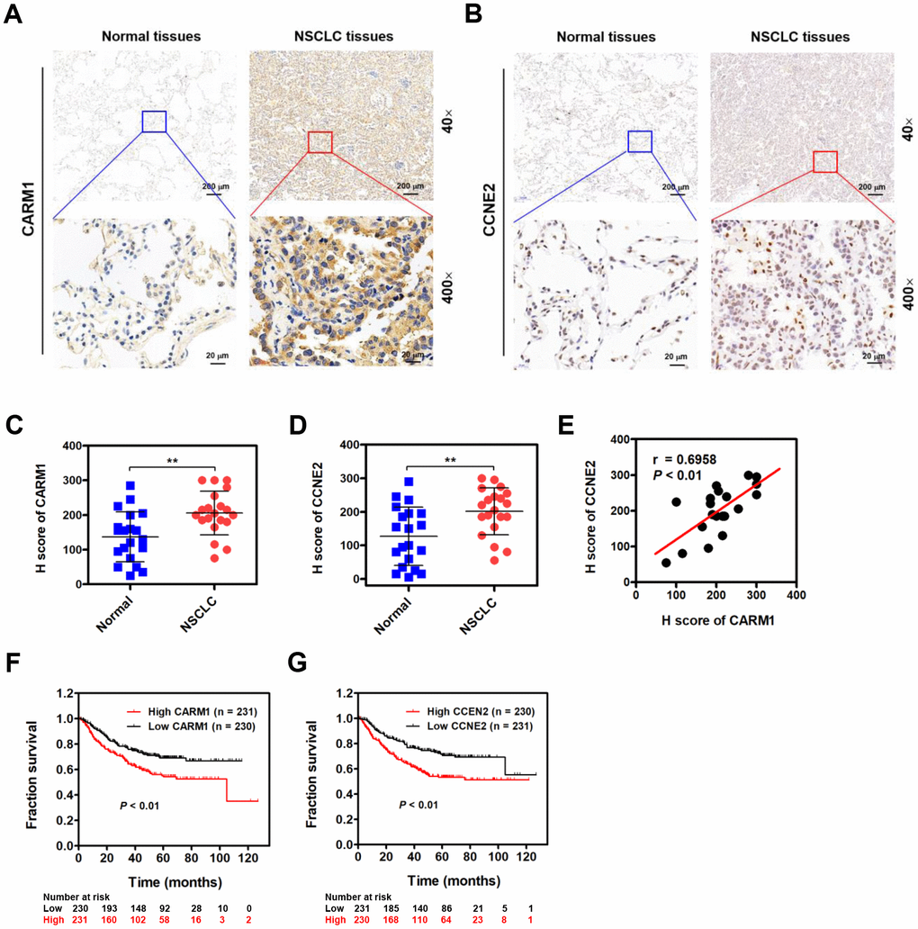 CARM1 is upregulated in NSCLC patients and positively correlated with CCNE2 levels. (A) Representative images of IHC staining of CARM1 in 20 cases of NSCLC patients (Tumor) and their adjacent non-tumor tissues (Normal). (B) Representative images of IHC staining of CCNE2 in 20 cases of NSCLC patients (Tumor) and their adjacent non-tumor tissues (Normal). (C) H score of CARM1 expression in 20 cases of NSCLC tumor tissues and their adjacent non-tumor tissues. **P D) H score of CCNE2 expression in 20 cases of NSCLC tumor tissues and their adjacent non-tumor tissues. **P E) Pearson correlation analysis was performed to examine the correlation between CARM1 and CCNE2 expression in 20 cases of NSCLC patients (n = 20; r = 0.6958; P F) Analysis of data from the Kaplan-Meier plotter database suggested that high expression of CARM1 (Cutoff value: 262) was associated with shorter 10-year overall survival of NSCLC (lung adenocarcinoma, n = 461) patients. P G) Analysis of data from the Kaplan-Meier plotter database suggested that high expression of CCNE2 (Cutoff value: 228) was associated with shorter 10-year overall survival of NSCLC (adenocarcinoma) patients. P 