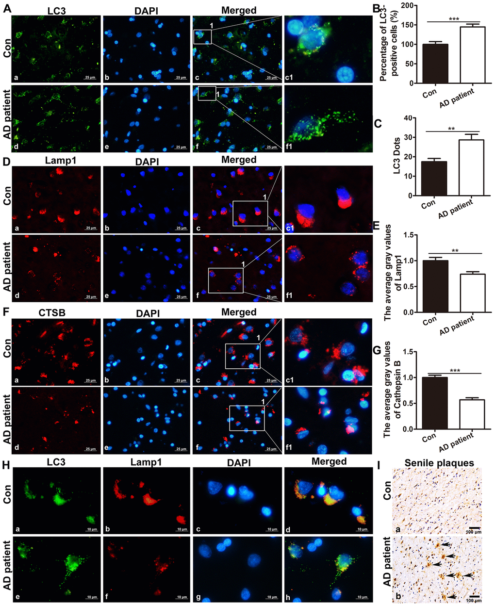 The expression of LC3, Lamp1 and CTSB in the brain of postmortem patients. (A) Immunofluorescence staining showed the expression of LC3 in the brain tissue of controls and AD patients (a, d: the expression of LC3; b, e: cell nuclei counterstained with DAPI; c, f: the merged images of Lamp1 and DAPI; c1 and f1 are partial magnifications of c and f. a-f: scale bar = 25 μm). (B) Quantitative analysis showing that the ratio of LC3-positive cells in the brain tissue. (C) Quantitative analysis showing the average LC3 puncta in brain tissue cells of AD patients and controls. (D) Immunofluorescence staining showing that the expression of Lamp1 in the brain tissue of controls (a-c1) and AD patients (d-f1). Scale bar = 25 μm. (E) Statistical analysis showing the average gray level of Lamp1. (F) Immunofluorescence staining showing that the expression of CTSB in the brain tissue of controls (a-c1) and AD patients (d-f1). Scale bar = 25 μm. (G) Statistical analysis showing the average gray level of CTSB. (H) Double immunofluorescence staining showing co-expression of autophagy- and lysosome-associated markers in the brain tissue of controls (a-d) and AD patients (c-f1). Scale bar = 10 μm. (I) Immunohistochemistry staining showing SPs in the postmortem cortexes of control patients (a) and AD patients (b), scale bar: 100 μm, the arrow indicates SP. The data are plotted as the mean ± SEM of three independent experiments and were analyzed by t test (**P 