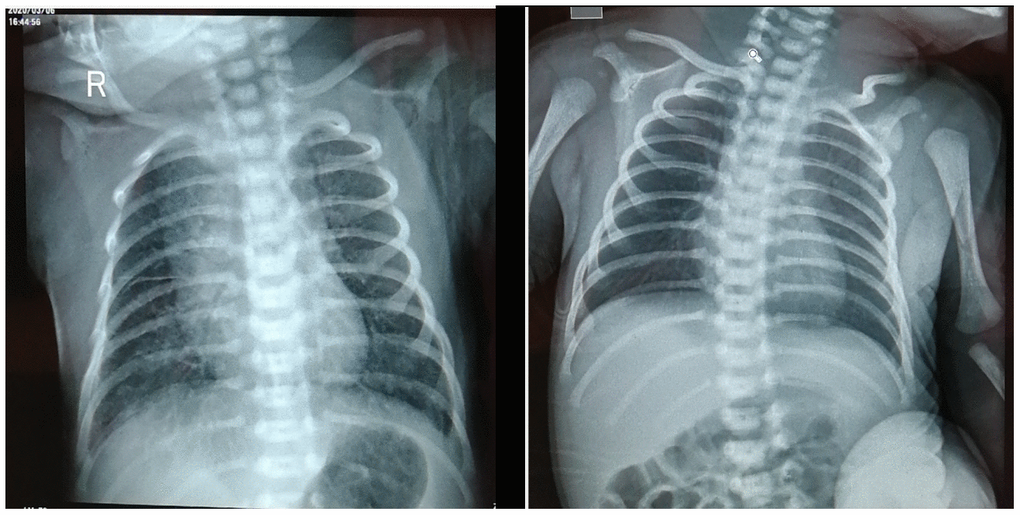 Chest X-ray of neonate on March 6th, 2020 (A) and March 12th, 2020 (B).